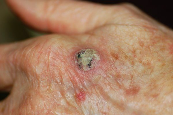 Carcinoma Espinocelular cirugía inmediata