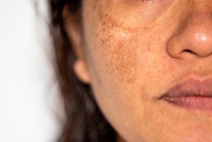 Cloasma y tratamiento médico en santiago