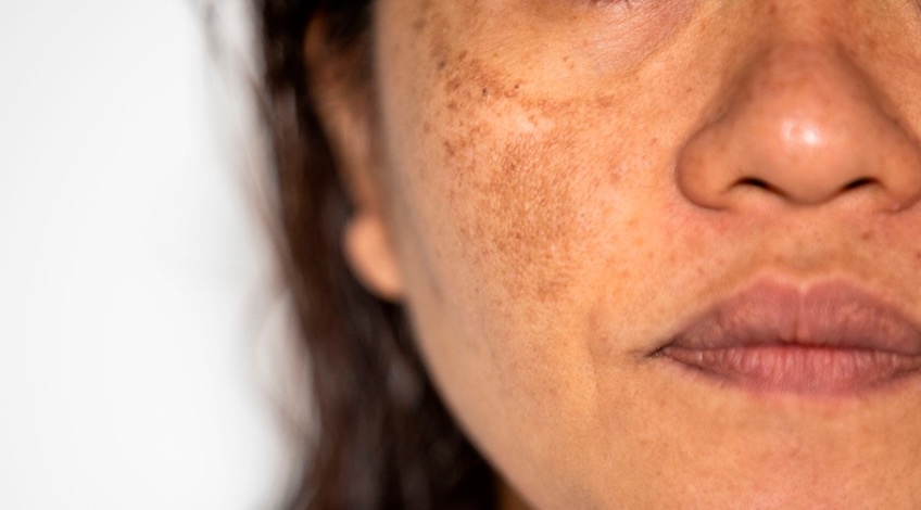 Cloasma y tratamiento médico en santiago