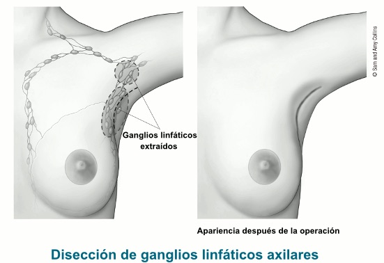Disección de Ganglios Linfáticos Axilares en santiago