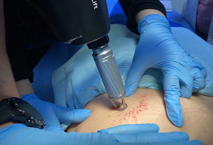 Estrías y Tratamiento Láser en santiago