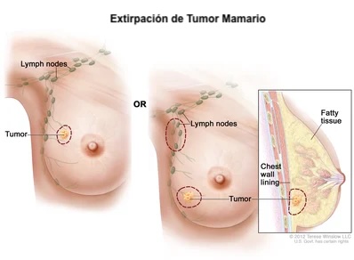 Extirpación de Tumor Mamario de urgencia