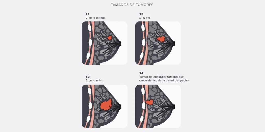 Extirpación de Tumores Mamarios Benignos o Malignos en santiago