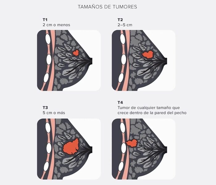 Extirpación de Tumores Mamarios Benignos o Malignos en santiago