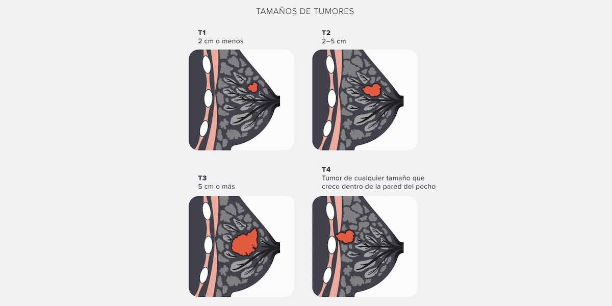 Extirpación de Tumores Mamarios Benignos o Malignos en santiago