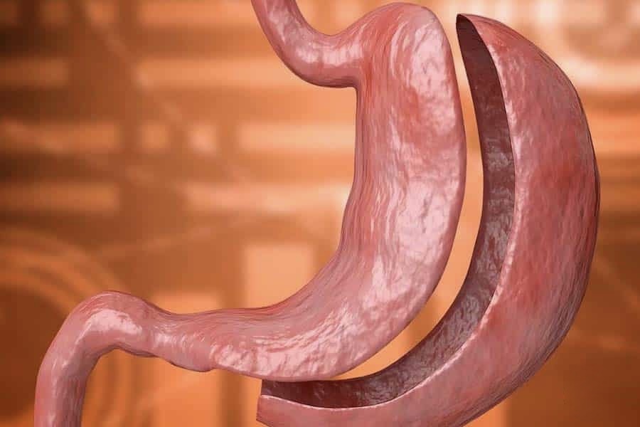 Gastrectomía en santiago