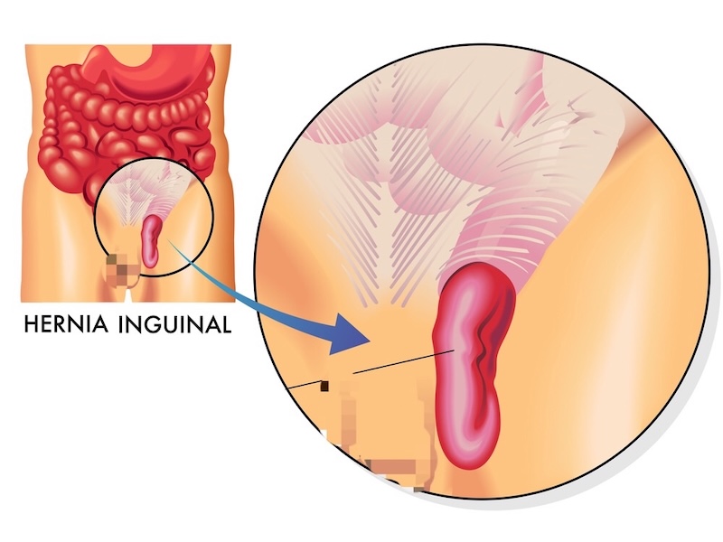 Hernioplastía en santiago