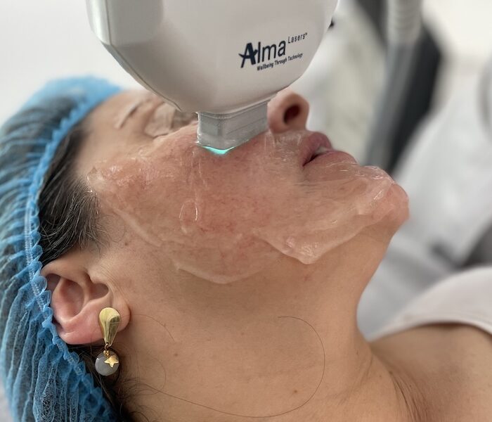 Lesiones Pigmentadas tratamiento médico láser