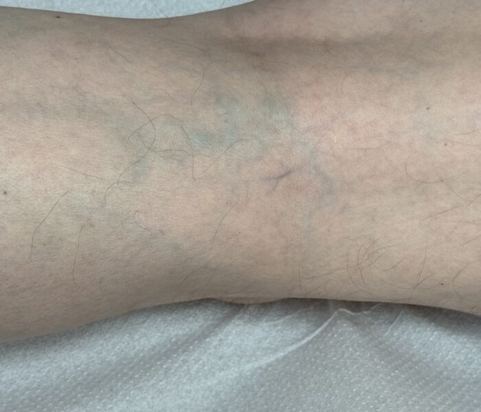 Malformaciones Venosas y tratamiento médico en santiago