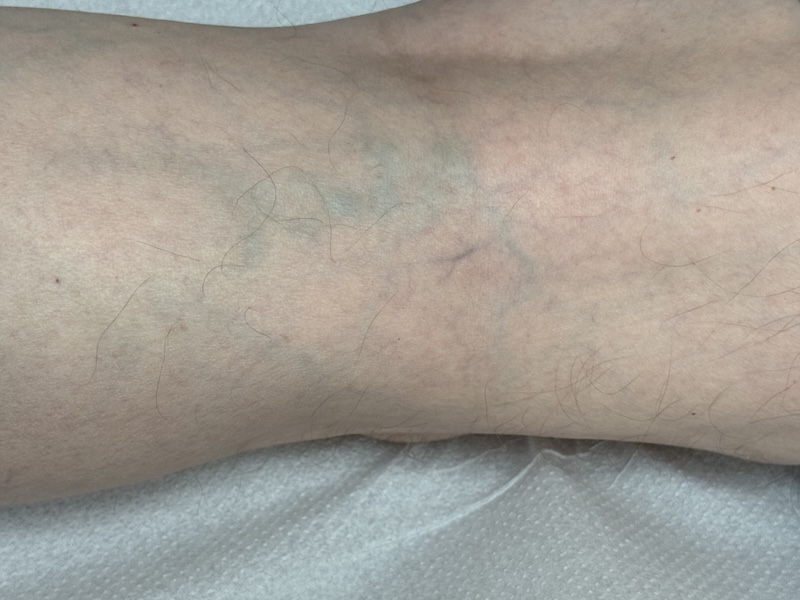 Malformaciones Venosas y tratamiento médico en santiago