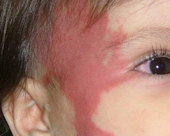 Manchas de Vino Oporto y tratamiento médico dermatológico