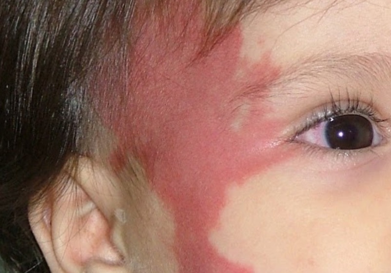 Manchas de Vino Oporto y tratamiento médico dermatológico