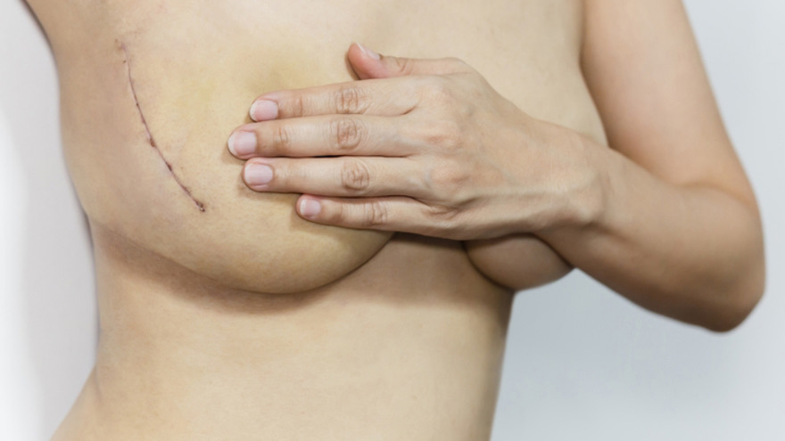 Mastectomia Simple y Radical en santiago