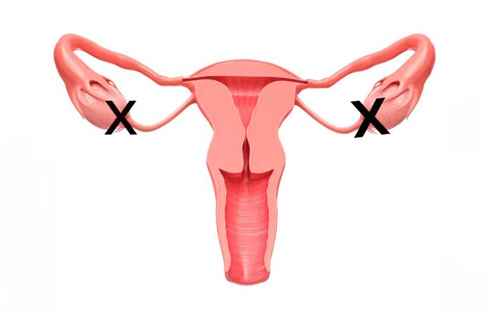 Ooforectomia Oncológica de urgencia