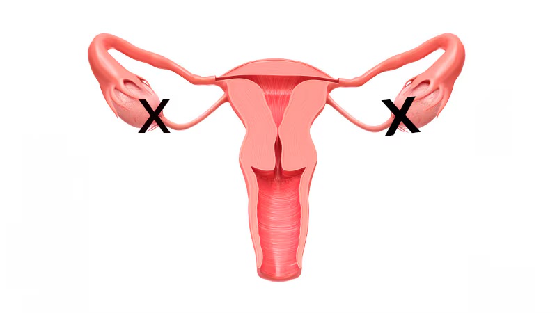 Ooforectomia Oncológica de urgencia