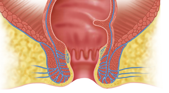 Papilas Anales tratamiento médico en santiago