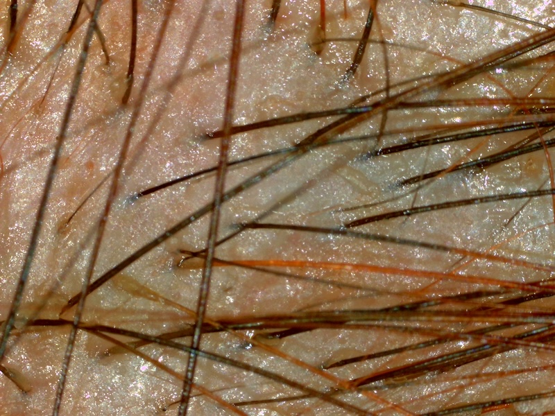 Tricograma Digital en santiago