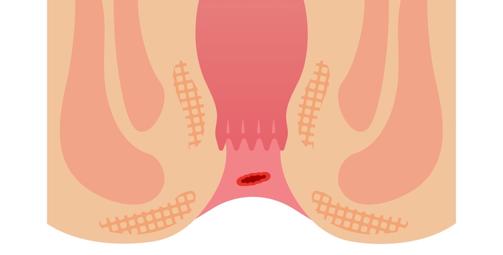 Úlceras Anales tratamiento en santiago