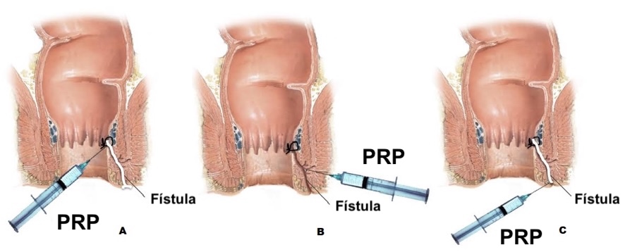 prp para heridas anales