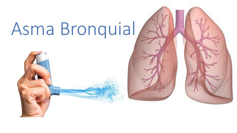 médico broncopulmonar especialista en tratamiento de Asma Bronquial
