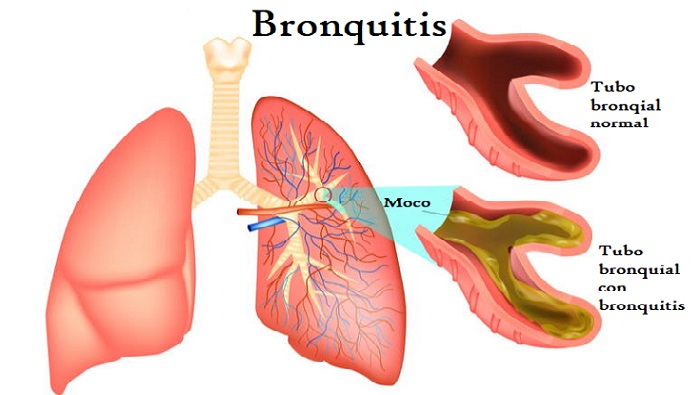 médico especialista en Bronquitis aguda y crónica