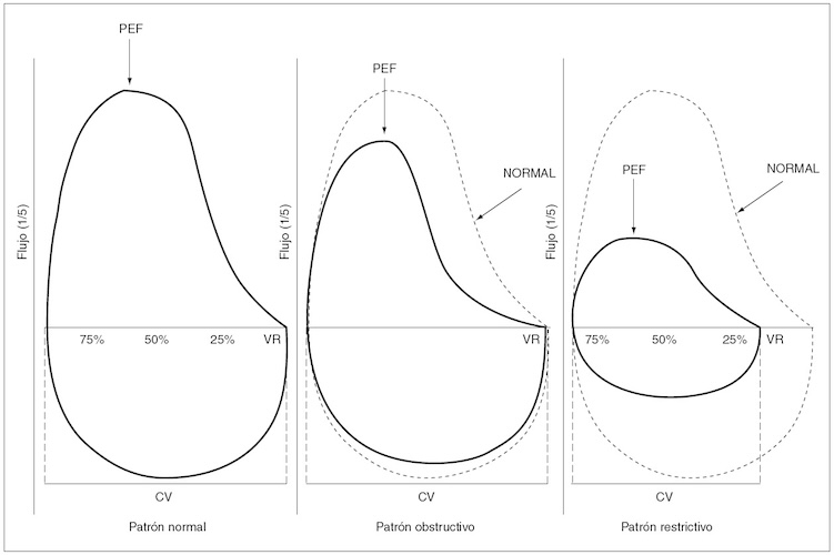test Curva de Relación Flujo Volumen Basal