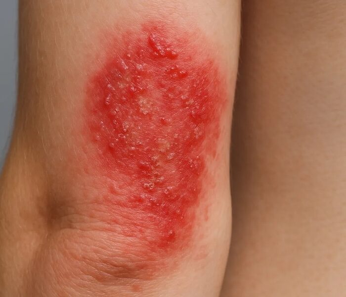 Eccema médico en santiago