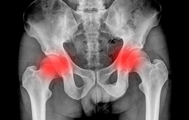 reumatólogo para tratar Espondilitis Anquilosante