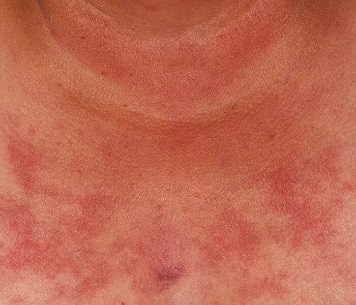 Lupus Cutáneo atención médica en santiago