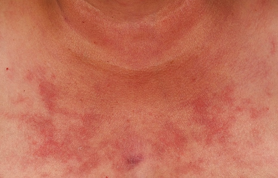 Lupus Cutáneo atención médica en santiago