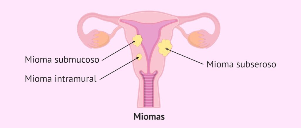 miomectomía en santiago