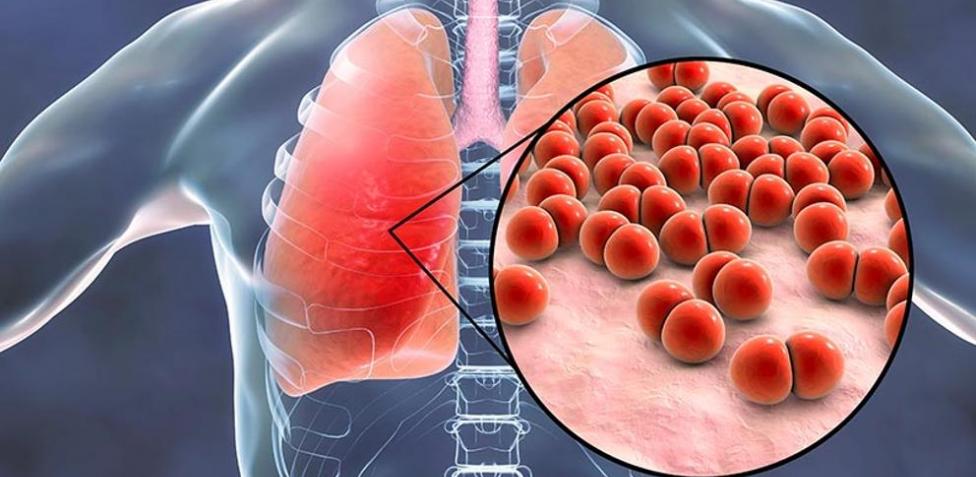 médico especialista en Neumonía