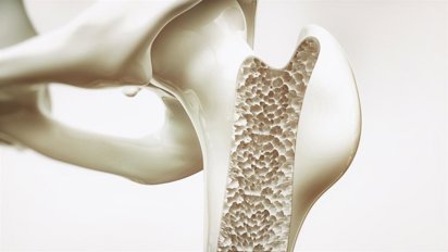 reumatólogo para tratar Osteoporosis