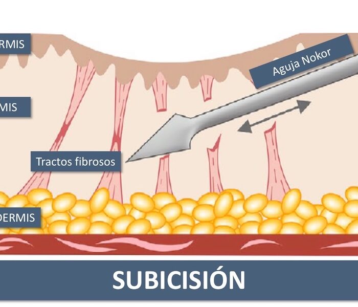 Subcisión de Cicatrices atención médica en santiago
