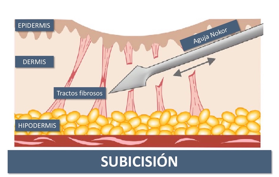 Subcisión de Cicatrices atención médica en santiago