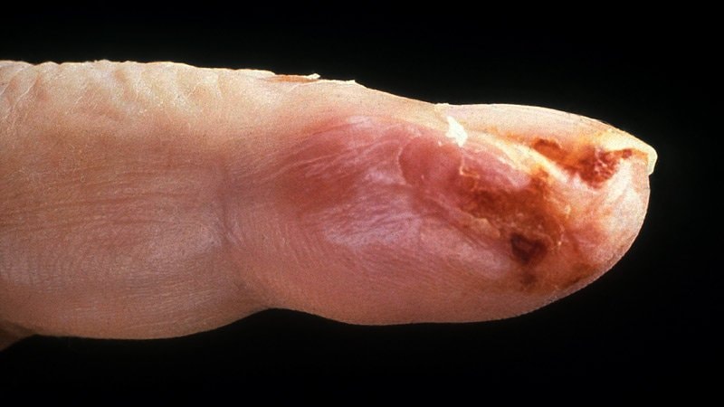 reumatólogo para tratar Vasculitis