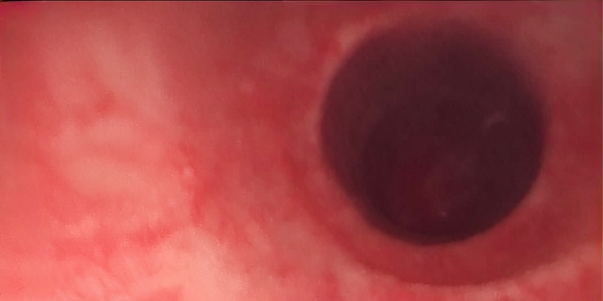 Cistoscopía en santiago