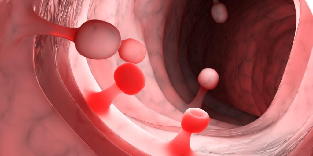 Pólipos Colorrectales cirugía en providencia