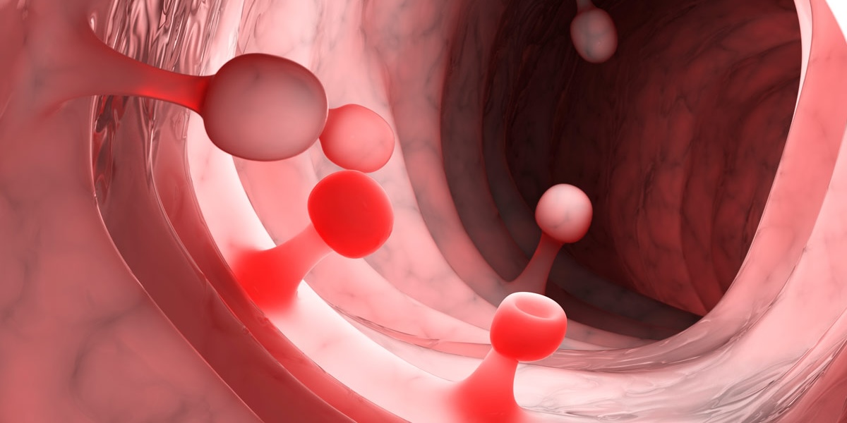 Pólipos Colorrectales cirugía en providencia