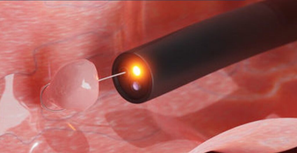 resectoscopía de urgencia