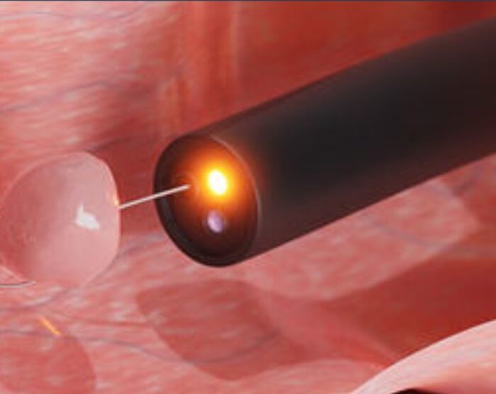 resectoscopía de urgencia