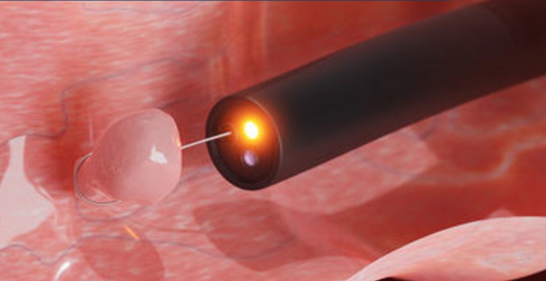 resectoscopía de urgencia