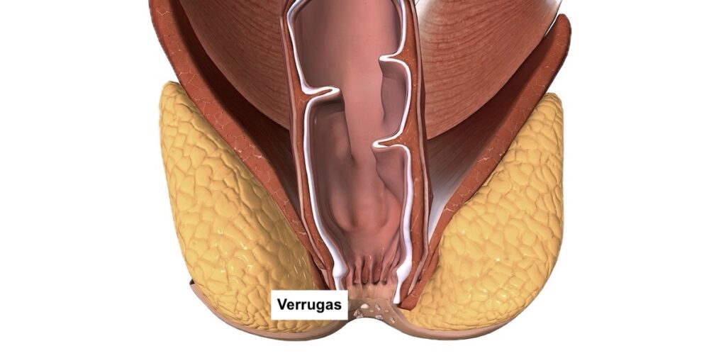 verrugas anales y tratamiento médico