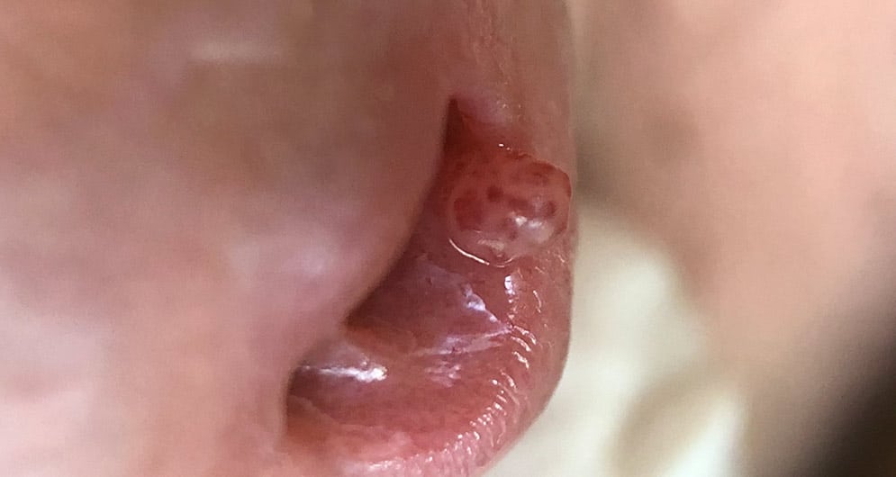 Verrugas en la Uretra cirugía de urgencia