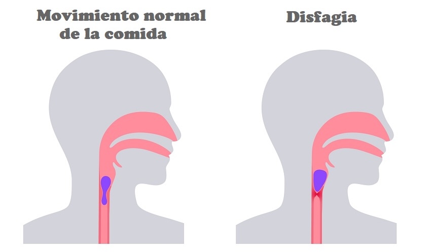 Disfagia médico en santiago