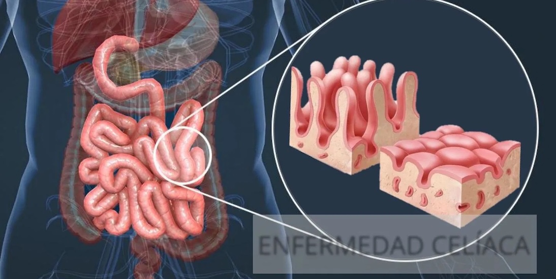 Enfermedad Celíaca tratamiento médico de urgencia