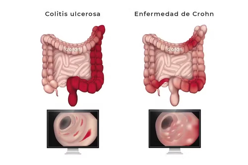Enfermedad de Crohn atención médica en santiago