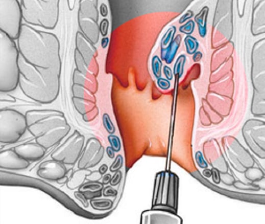 Escleroterapia para Hemorroides de urgencia en santiago