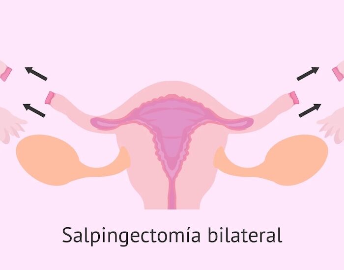 Salpingectomía en santiago