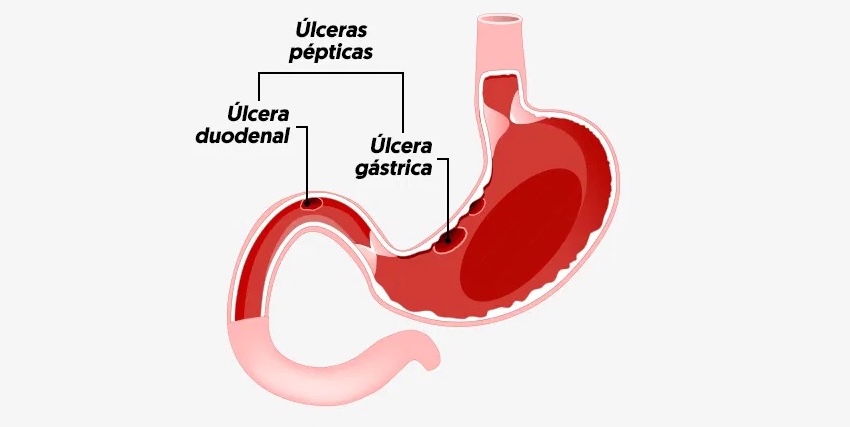 Úlcera gástrica médico en santiago